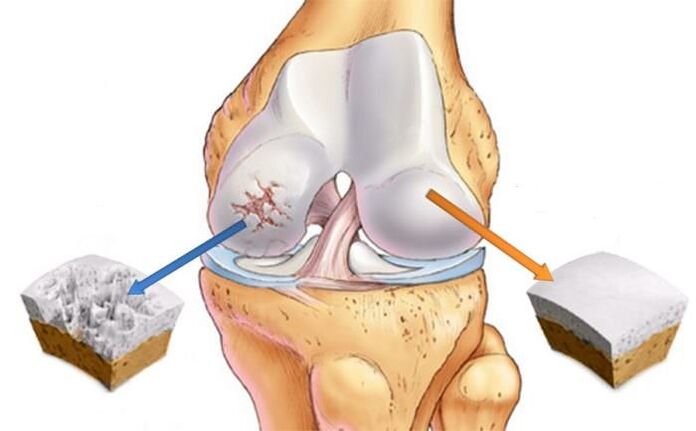 What is arthrosis