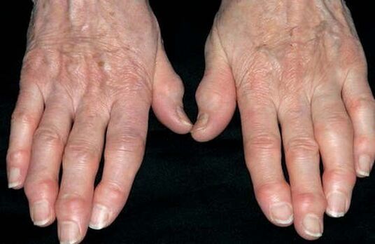 Arthrosis of the hand