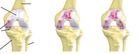 The degree of arthrosis
