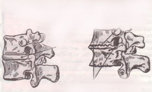 The intervertebral disc is healthy and with lumbar osteochondrosis