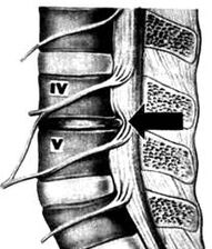 X -ray picture of the lumbar department osteochondrosis