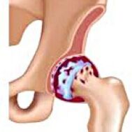 Arthrosis of the hip joint