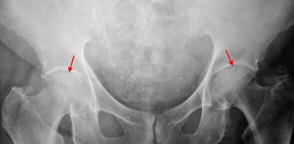 Coksartrosis coiled two joint gaps, articular surface sclerosis