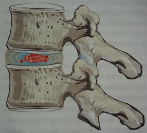 The first stage of osteochondrosis