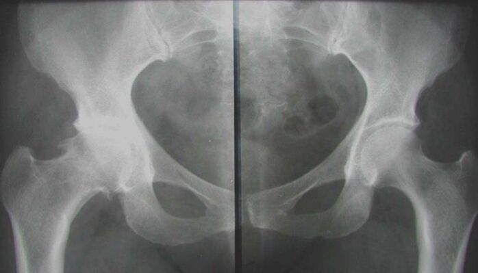x-ray of the affected hip joint with arthrosis